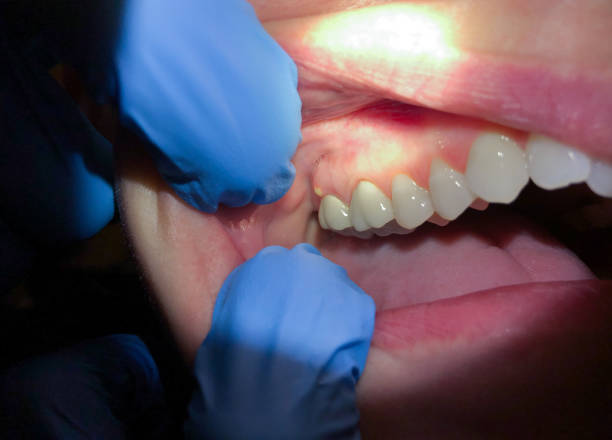 Best Chipped Tooth Repair Near Me  in Kerhonkson, NY